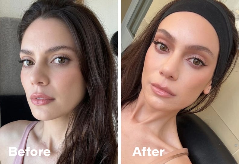 Brow lift before and after